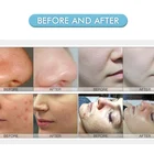 Micro Dermabrasion New Arrival Diamond Hydra Micro Dermabrasion Skin Dehydration Clean Treatment Machine