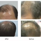 FDA approved Kernel KN-8000B/C LLLT laser diode hair growth helmet for hair loss alopecia treatment