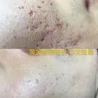 Portable Rf Rf Portable Fractional Rf Microneedling Machine Korea And Rf Cartridge Insulated Needles
