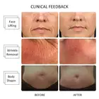 Beautemed Wrinkle Removal Body Slimming Machine 25000 Shots 3D Hifu Machine With 8 Different Handles