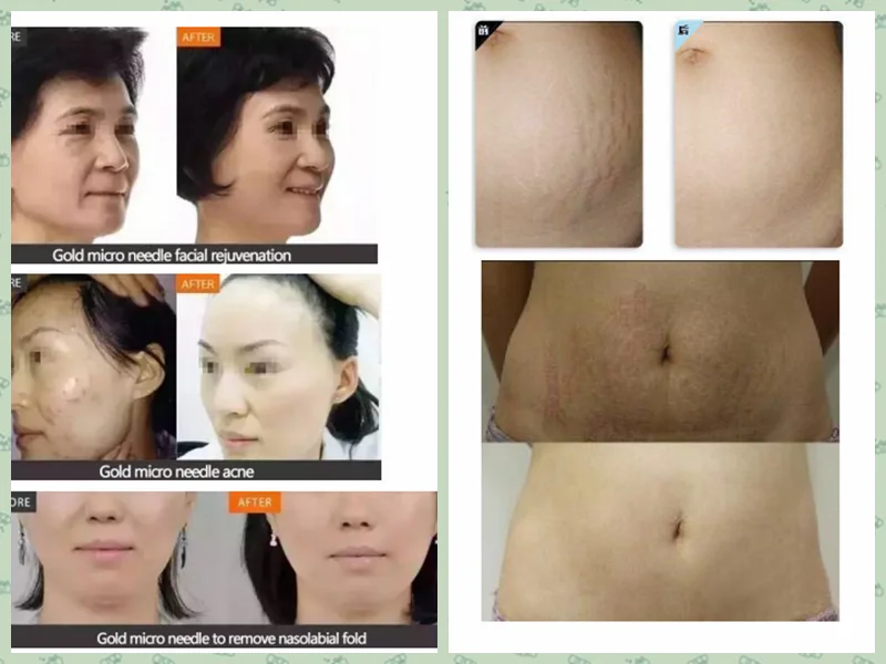 2021 best sell products rf microneedle fractional machine wrinkles reduction/skin rejuvenation/scars removal Sincoheren