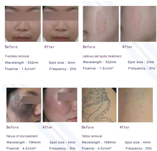 Purchasing Festival Beijing Sincoheren laser q switch 1064 532 tattoo removal beauty salon equipment