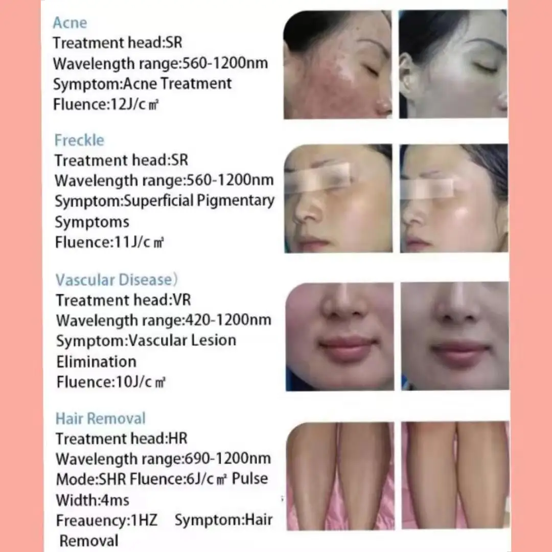 Sincoheren OPT SHR IPL Hair Removal Skin Collagen Rejuvenation Machine