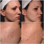 Nd Yag Laser Professional 600ps Picosecond Q Switched Tattoo Removal Machine Picosure 110mm Spot Size