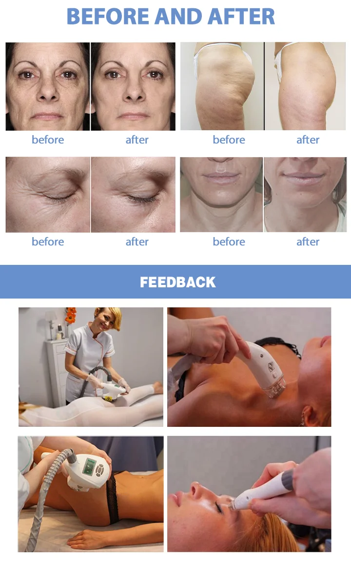 cellushape Pro cellulite reduction body contouring cavitation RF machine fat removal liposuction and facial aesthetics