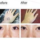 Professinal Laser Pigment Removal Picosecond Laser Pen Hot Sale Laser Tattoo Pigment Removal