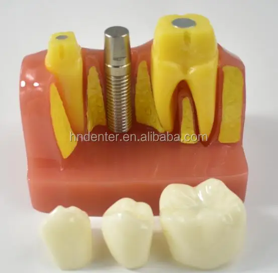 dental implant model