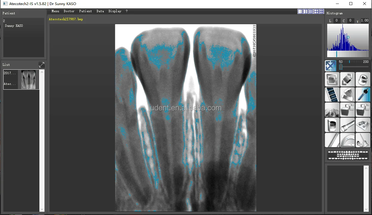 dental xray sensor digital sensor uk sensor usb dental x-ray