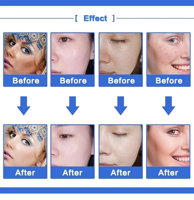fractional rf microneedle machine