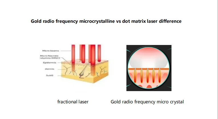 2021 best sell products rf microneedle fractional machine wrinkles reduction/skin rejuvenation/scars removal Sincoheren