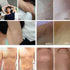 Diodo Laser 808nm Depilation Machine Lazer Hair Removal Portable