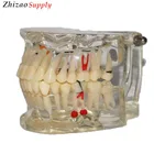 Dental Implant tooth dental pathological model