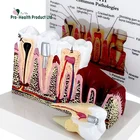 Dental Study Plastic Periodontal Teeth Human Medical Decay Common Pathologies Teeth Model