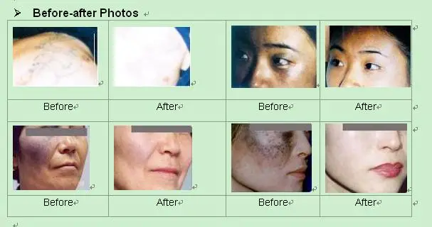 Before and after