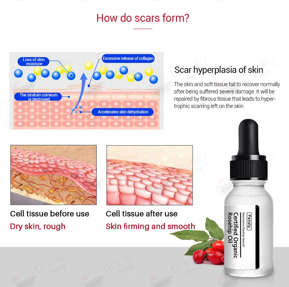 stretch mark oil (3).jpg