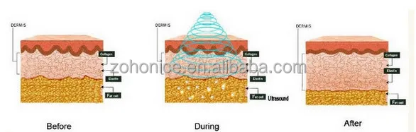 body slimming liposuction RF Laser cavitation Vacumm Polar