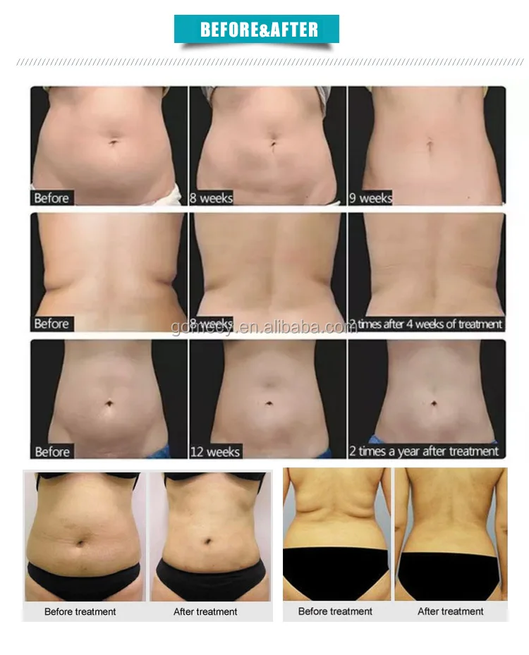 factory price hot selling portable home use mini liposonix liposonic body shaping device fat removal slimming machine.jpg