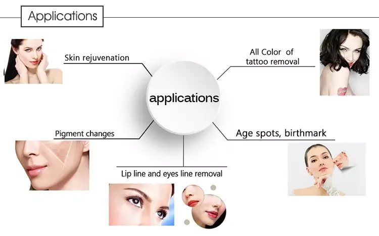 nd yag q-switch laser spot removal/q switched nd yag laser tattoo removal machine 2020/picosecond laser handle tattoo removal ma