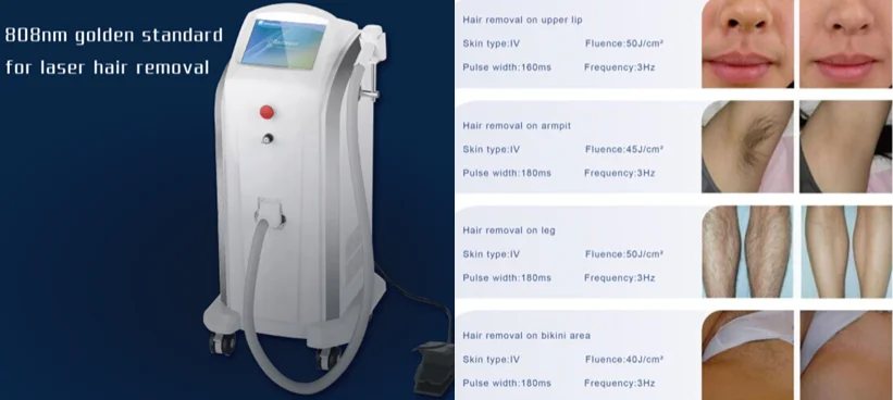 epilatore laser alexandrite candela gentlelase epilatore laser alexandrite candela gentlelase