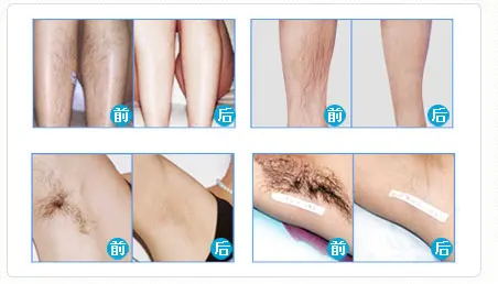 Home Ipl Hair Removal | Laser Hair Removal/Female Hair Removal Machine