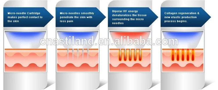 Machine radio frequency facial treatment Microneedle rf