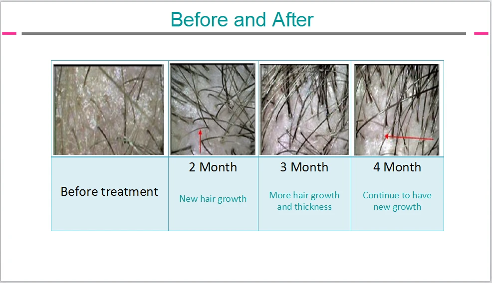 Low Level Laser Therapy Hair Restoration Boston Rhode ...