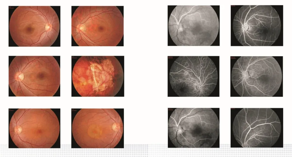 APS-DER B Type Fundus Camera & Fundus Fluoresceion Angiography New Product Fundus Camera & FFA