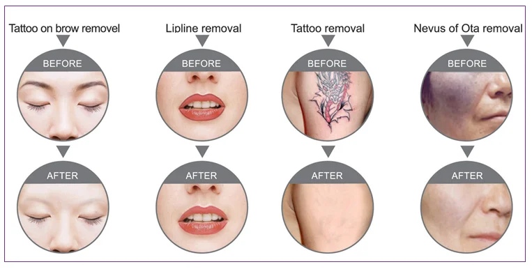 New arrival portable machine for facial blemishes removal with high quality