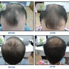 Hair Regrowth Hair Regrowth Hair Transplant Diode Laser Hair Regrowth Device