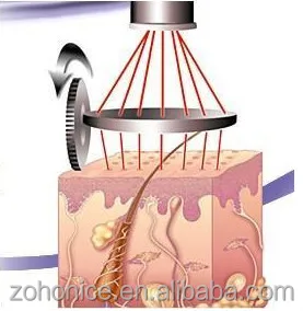 Co2 Laser skin resurfacing scar removal warts removal/co2 laser vaginal applicator vertical model high performance