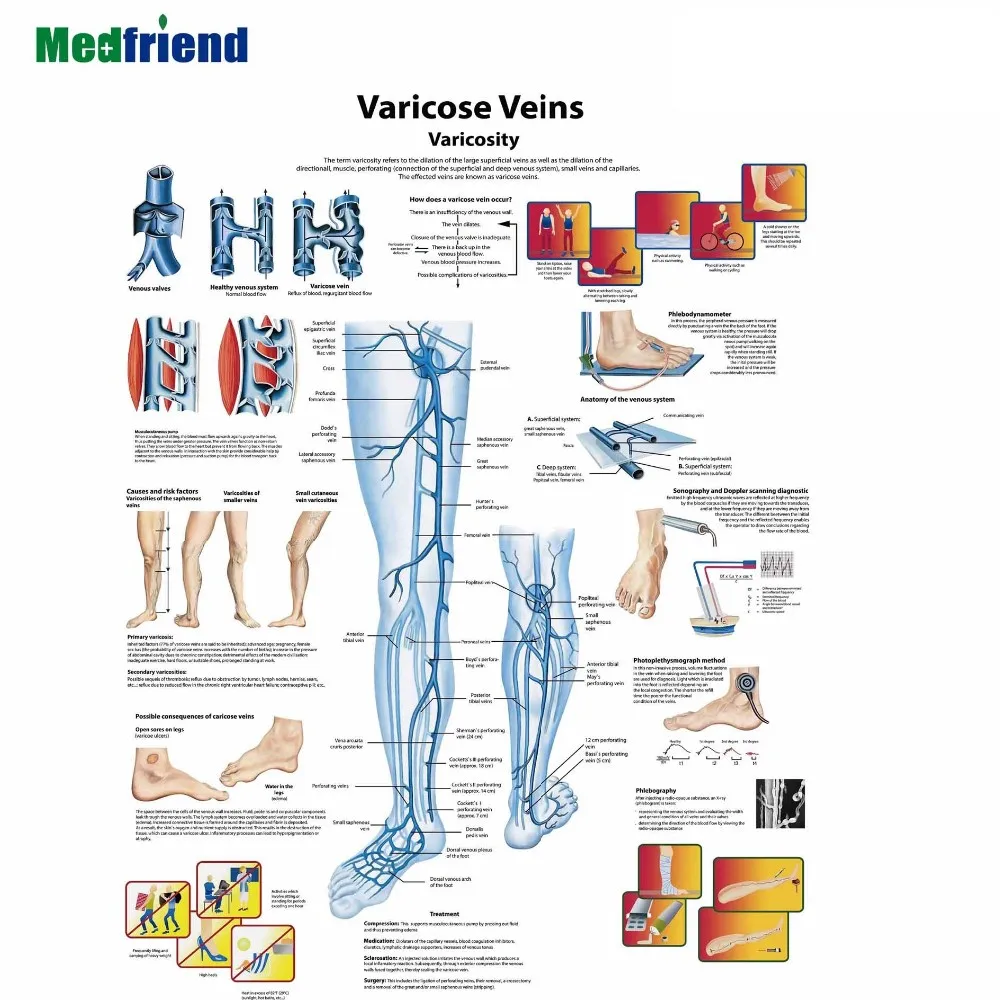 许可的教育塑料 3d 医疗解剖墙图/海报-静脉曲张
