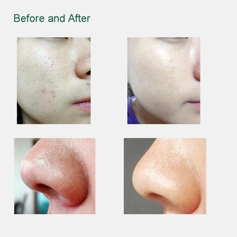 CE certificate Wrinkle removing machine/Blackhead Removal machine/diamond microdermabrasion machine for personal use