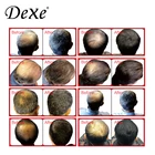 Hair Loss Best Anti Hair Loss Product Dexe Anti Hair Loss Lotion For Hair Regrowth