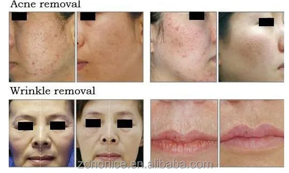 Co2 Laser skin resurfacing scar removal warts removal/co2 laser vaginal applicator vertical model high performance