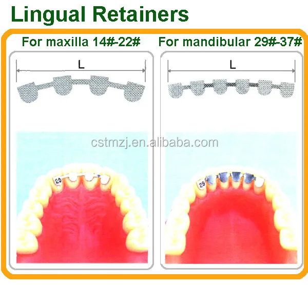 lingual retainers 2