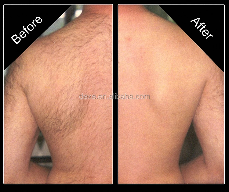 Back-Laser-Hair-Removal-2