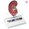 5.5" x 3.9" x 6.5" Medical quality human anatomical Kidney Stone Model