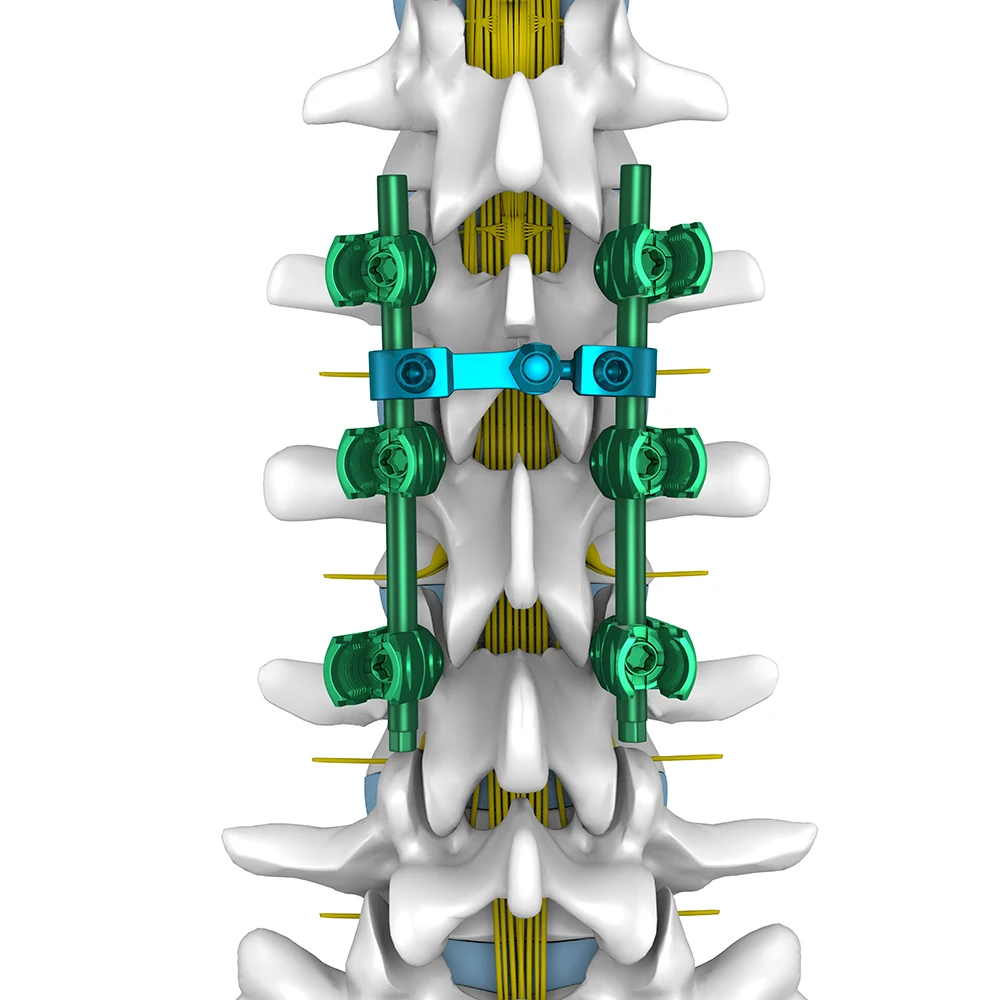 ce spinal internal fixation system pedicle reduction screws