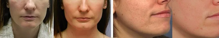 before and after