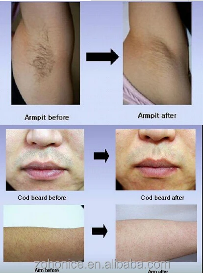 Multilingual spare parts for 810nmnm laser