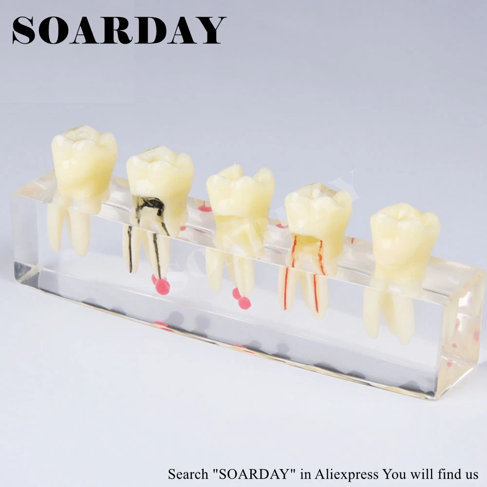 Tooth Root Canal Restoration Model (4)