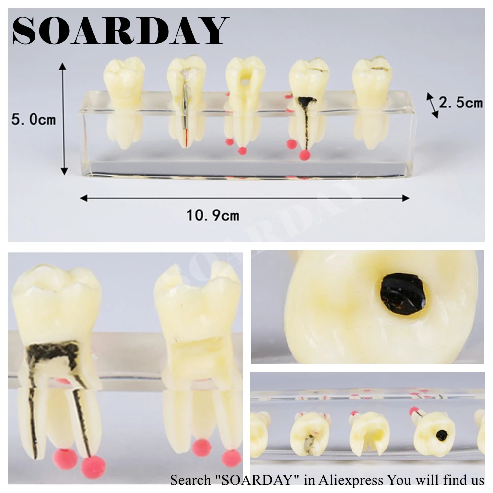 Tooth Root Canal Restoration Model (5)