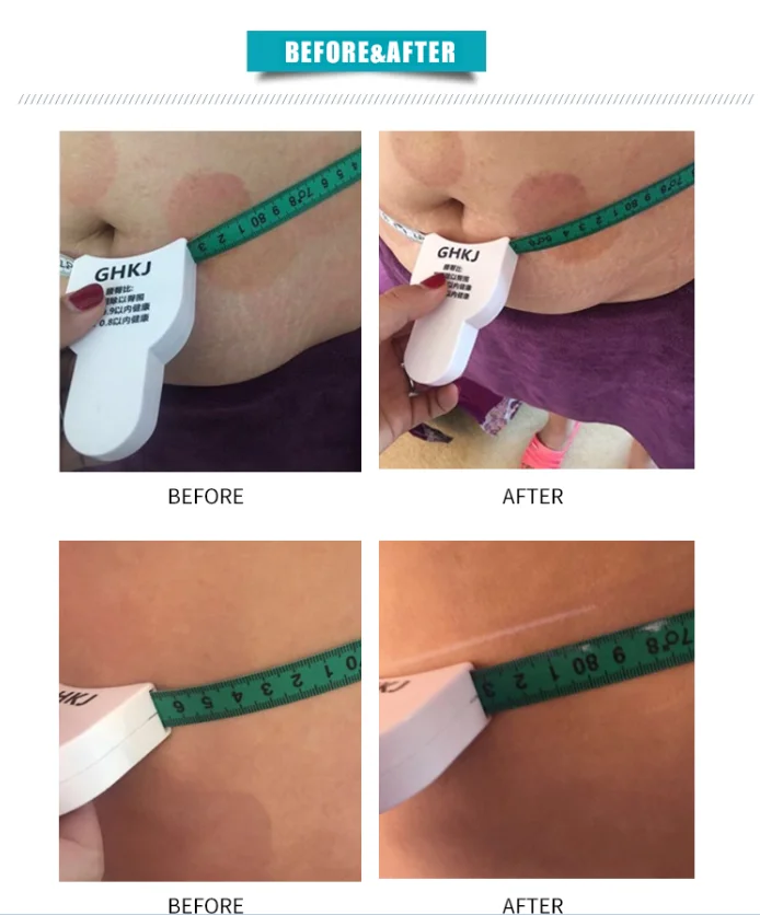 Good effects 2 IN 1 hifu and liposonix machine with 5 cartridges for face lifting and body slimming .jpg