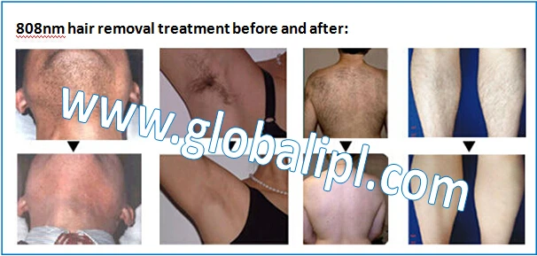 GLOBALIPL handle with big spot size and small size diode laser 808 hair removal