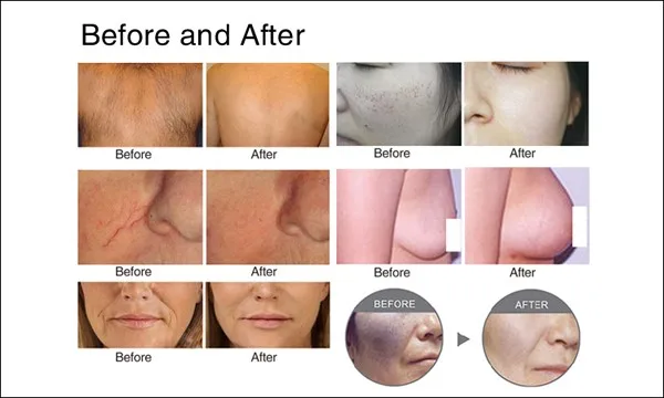 SHR OPT IPL beauty machine