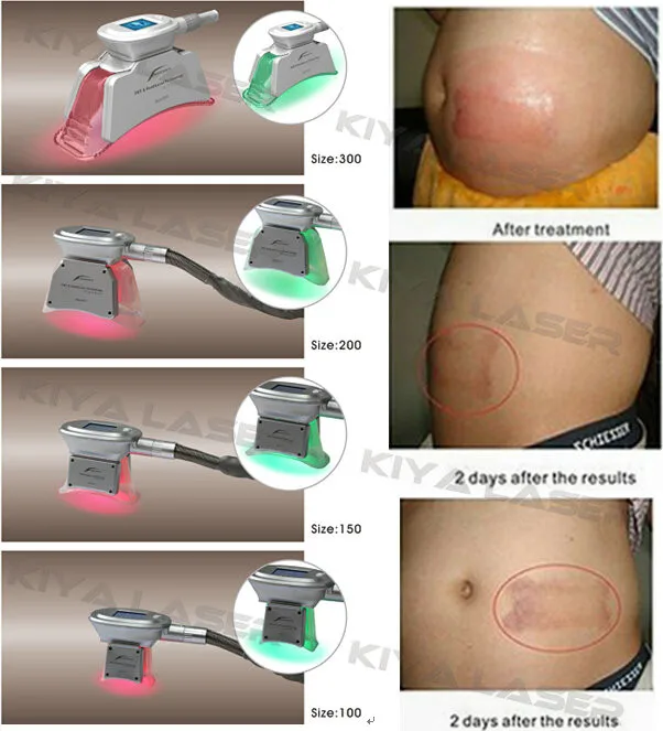 cool sculpting machines.jpg