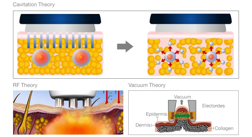 rf home use face lift devices.jpg