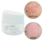 Skin care ALOE VERA removal ance moisturizing nourishing soothing mild acne treatment cream