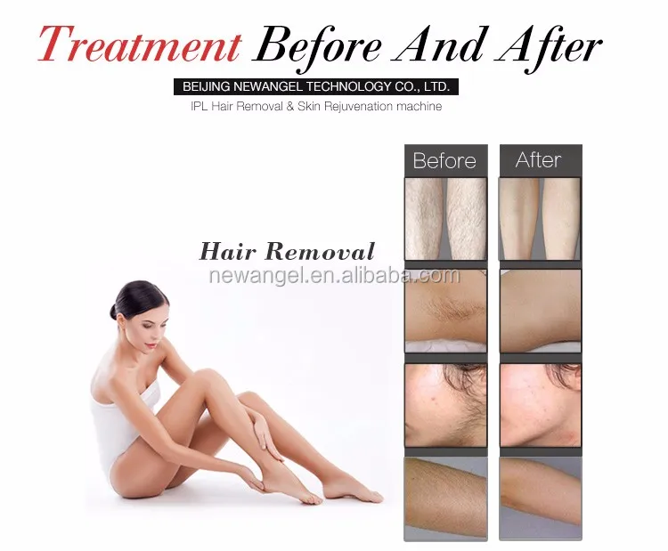 IPL-before-and-after_01.jpg