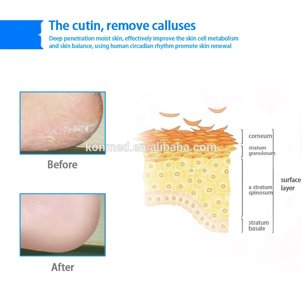 The cutin,remove calluses heel care